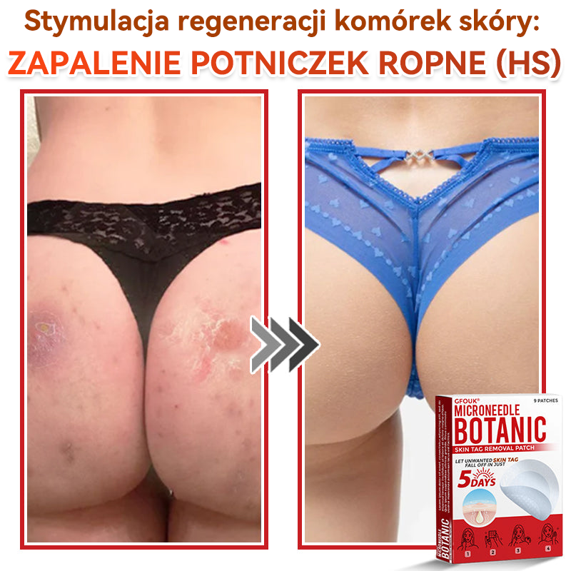 🏆 GFOUK® Plastry do usuwania brodawek i znamion z mikronakłuciami roślinnymi