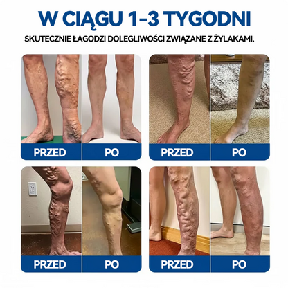 🇵🇱👨‍⚕️✅TAILEDEN® VeinEase Plastry z Mikronakłuciami⚡Natychmiastowa ulga, długotrwałe rezultaty